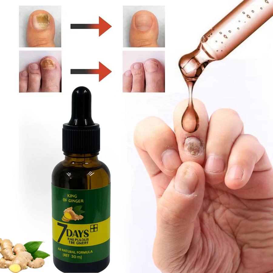 Elimina el Hongo de tus Uñas en 7 Días + Envío Gratis